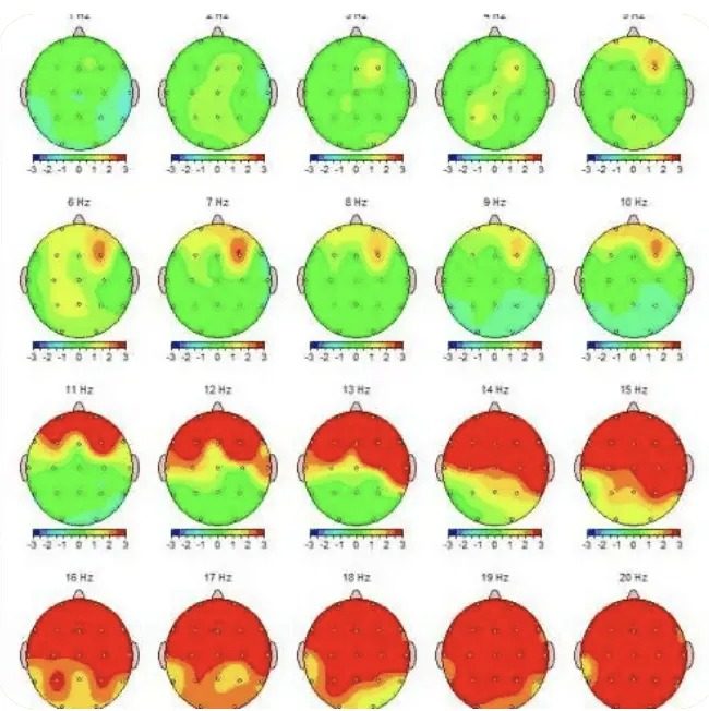 A grid of QEEG topographic brain maps across frequency bands